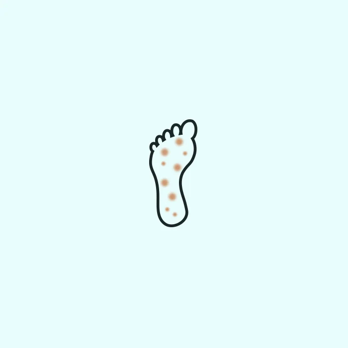 Neuropathy